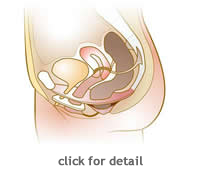Stress urinary incontinence: MedlinePlus Medical Encyclopedia